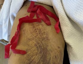 post operative care