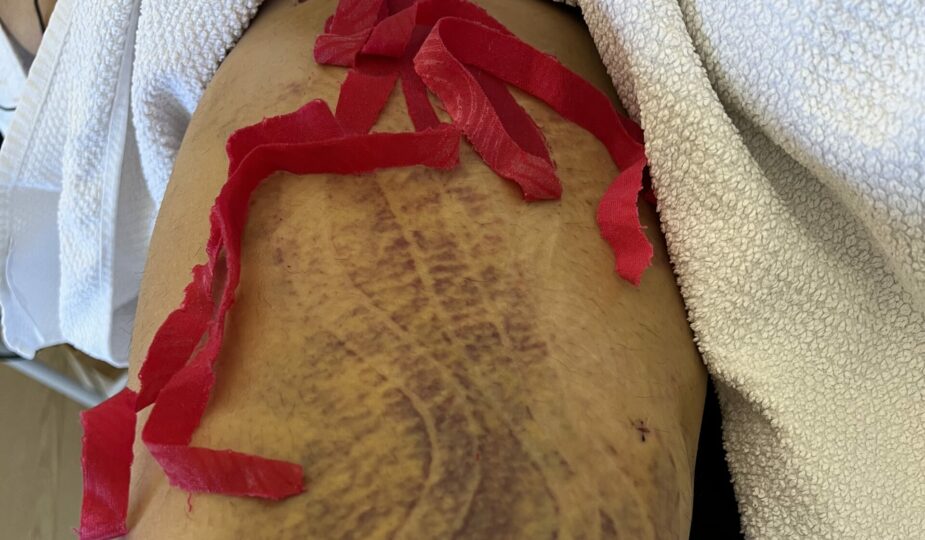 post operative care