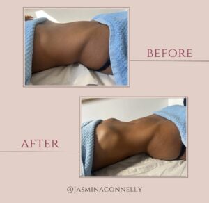 wood therapy and Brazilian body sculpting treatment results
