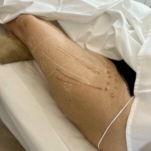 manual lymphatic drainage