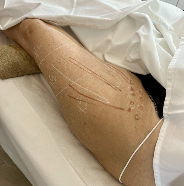 manual lymphatic drainage
